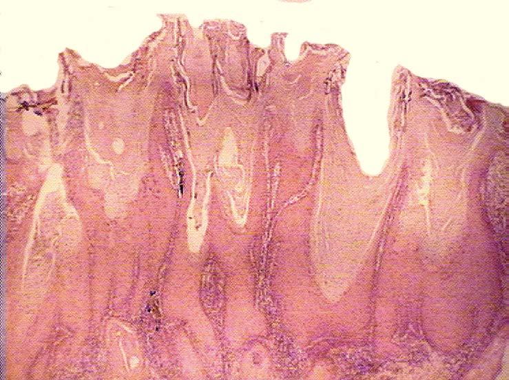 PVL HISTOLOGY ATYPICAL