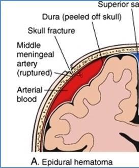 Extradural hemorrhage / epidural The most common artery to be damaged is the anterior division of the middle meningeal artery Results from a blow to the side of the head, resulting in fracture of the