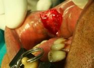 2: Surgical excision  3: