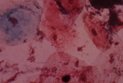 Cytology of Lichen Oris