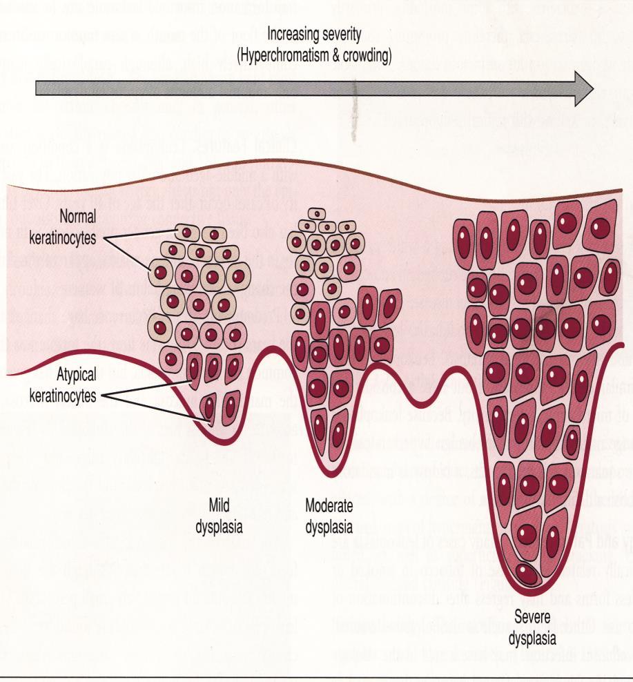 Pathogenesis Leukoplakia is a defense mechanism of the oral mucosa against any irritativ