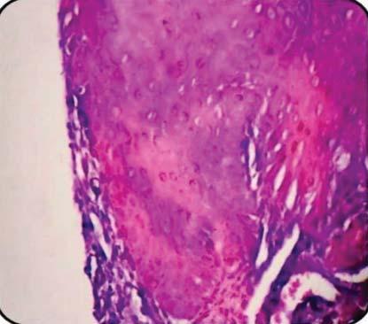 Histopathology Histopathological examination revealed stratified squamous epithelium which was hyperkeratotic in nature. The rete ridges were bulbous/drop shaped, with basilar hyperplasia.