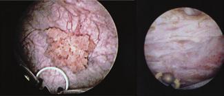 A complete TUR removes not only the visible epithelial portion of tumours, but also the invisible microscopic mucosal or invasive tumour, including deep muscle.
