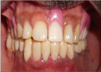 14: Temporary full mouth occlusal