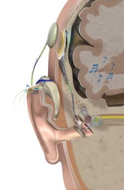 Cochlear Implant: What is it? Sound waves enter through the microphone. The sound processor converts the sound into a distinctive digital code.