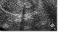 Ultrasound control Avoid fundal contact