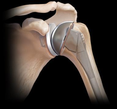 This is known as the gleno-humeral joint. When arthritis affects the shoulder it can cause the lining of these joint surfaces to wear, causing pain and stiffness.