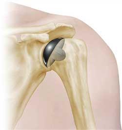 Replacing the worn surfaces with a replacement surface (prosthesis) will reduce the amount of pain and increase the range of movement available from your shoulder joint.
