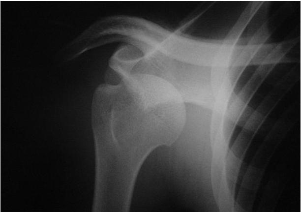 SHOULDER DISLOCATION TREATMENT EARLY