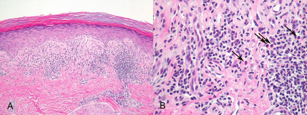 D, Dysplastic junctional melanocytic nevus showing architectural atypia with bridging of irregular junctional nests (hematoxylin-eosin, original magnifications 320 [A, B, and D] and 3100 [C]).