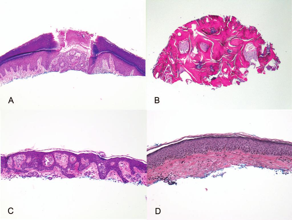 Figure 4. Partial biopsies requiring caution in pathology sign-out. A, Partial sampling of an acral actinic keratosis, but invasive carcinoma cannot be excluded.
