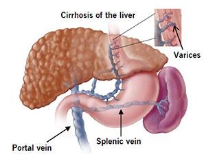 Bleeding complications in liver disease Variceal bleeding