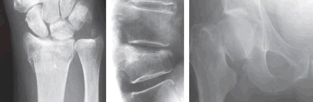 Journal of Medical Sciences (2010); 3(3) AHMED ET AL. Fig. (1). Typical sites of osteoporotic fracture: wrist (left), spine (centre) and hip (right).
