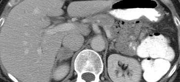 6 YEARS LATER: CHEST CT