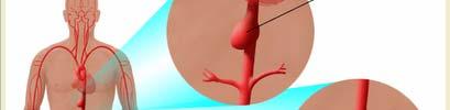 arteries Infra-renal (95% of