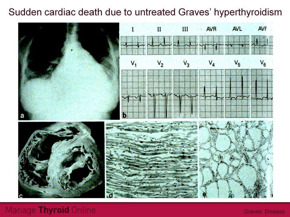 Patients with Graves disease are at low risk of sudden cardiac arrest induced by thyroid storm.