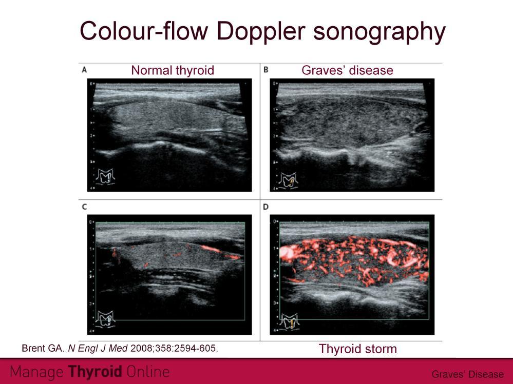 Colour-flow Doppler sonography can be used to assess the health of the thyroid gland.