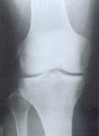 on MRI in knees without radiographic osteoarthritis stratified by age group