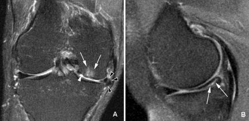 multiple abnormalities on MRI indicating early stage osteoarthritis despite