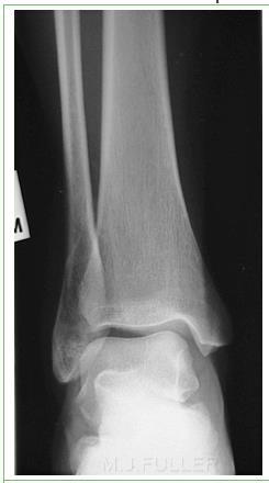 Knee with multiple abnormalities on MRI indicating early stage osteoarthritis despite lack of radiographic osteoarthritis.