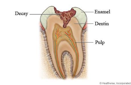 Tooth Decay o Coating of bacteria and food on teeth o The bacteria respiring sugars in the food, producing acid which dissolves the enamel and dentine o