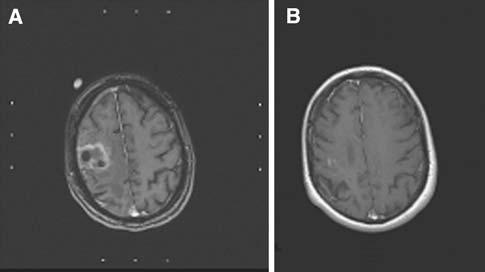 with WHO grade II astrocytoma at the age of 54. After stereotactic biopsy at primary diagnosis, postoperative RT was performed up to a total dose of 60 Gy.