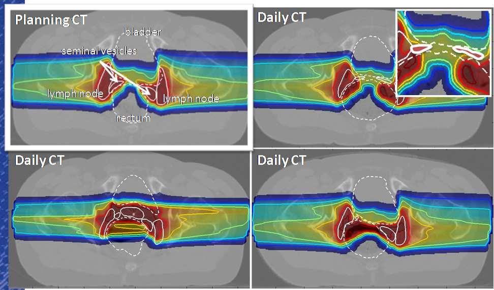 Uncertainties in Proton Therapy 1. The potential effects of calculation uncertainties 2.
