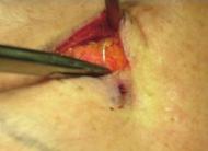 a 24-mm needle and a 7-0 nylon thread were passed into the subcutaneous layer in the anterior and inferior directions to avoid damaging the eyeball (Fig. 2).