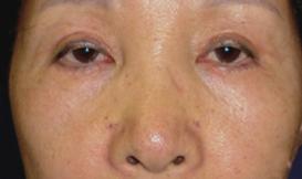 fter lower eyelid blepharoplasty, based on the redistribution fat and skin resection, the patient achieved great