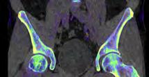 Rho/Z (Liver VNC) Virtual Unenhanced Brain Hemorrhage Monoenergetic
