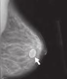 What can a mammogram show? Normal mammogram Benign cyst (not cancer) Cancer Mammograms can show lumps, calcifications, and other changes in your breast.