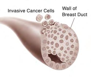 Breast cancer Breast cancer is a disease in which cancer cells form in the tissues of the breast.