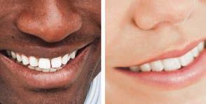 what is invisalign?