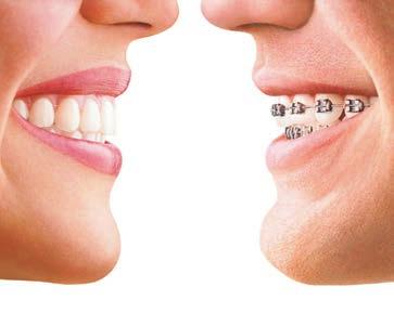 to make Invisalign work for you: n You will need to have attachments bonded to your teeth.