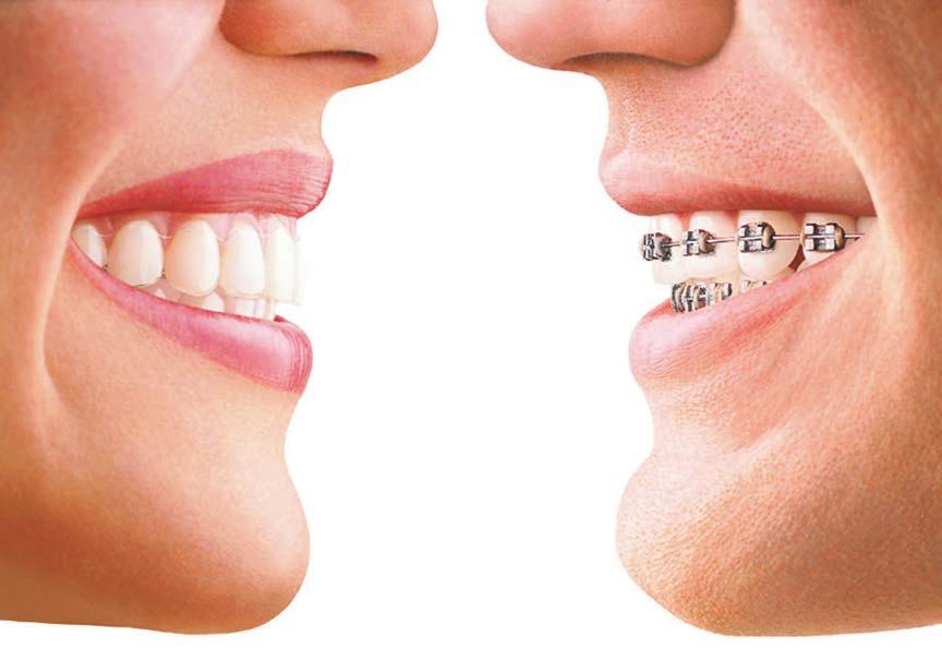 Is Invisalign the only way to straighten my teeth? Invisalign is not the only method of straightening teeth, and it doesn t work for everyone.