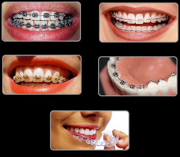 ABOUT BRACES Does the Age A ect the Success of Braces? The mechanical process used to move teeth with braces is the same at any age.