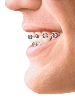 INVISALIGN: STRAIGHT TEETH, NO BRACES Invisalign, the clear alternative to braces, is the invisible way to straighten teeth for both adults and teens using a series of