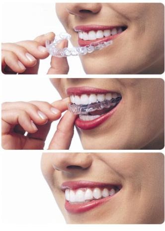 We aim to provide you with the most advanced, almost invisible orthodontic treatment techniques available utilising Invisalign.