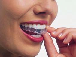 Incognito is customised to your specific needs and sits comfortably behind your teeth so only you know that it s there.