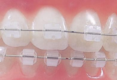 From traditional braces to invisible