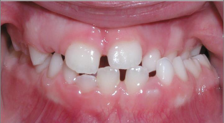 Malocclusion: Bad Bite Can lead to: Tooth