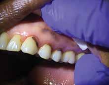 2. Horst J, Ellenikiotis H, Milgrom P UCSF Protocol for caries arrest using Silver Diamine Fluoride: Rationale, Indications and Consent California Dental Association Journal