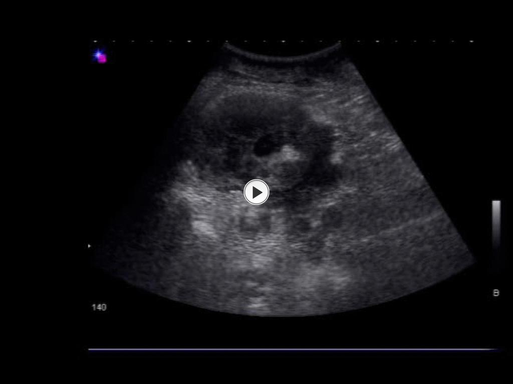 Fig. 18 Female with non-hodgkin lymphoma presents with a nodular lesion at the level