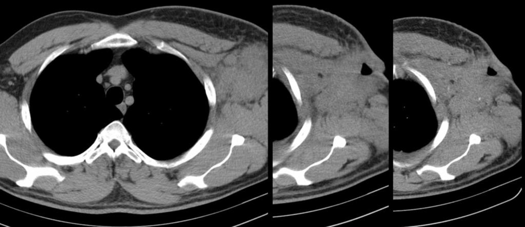 Fig. 21 on page 18: heterogenous splenic mass showing both on CT and ultrasound in NHL patient. Fig.