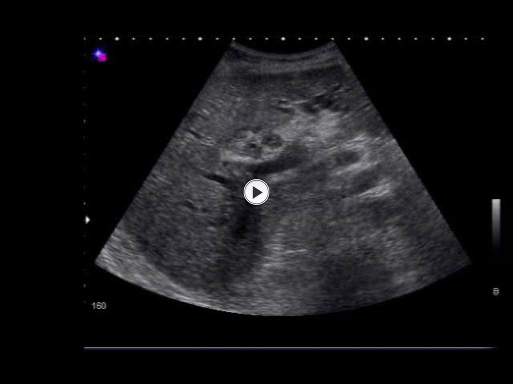 Fig. 15 A 69-year-old female with NHL; Ultrasound examination shows the polynodular mass that surrounds the renal vein and artery but without Doppler signal alteration.