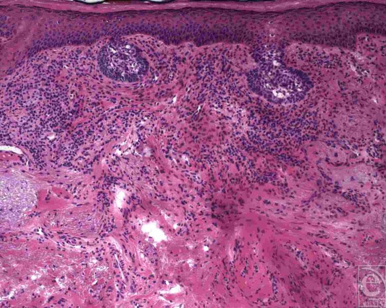 JADOTTE ET AL Superficial spreading basal cell carcinoma tends to spread widely with skip areas in which no tumor is present, compromising the earlier mentioned treatment approaches.