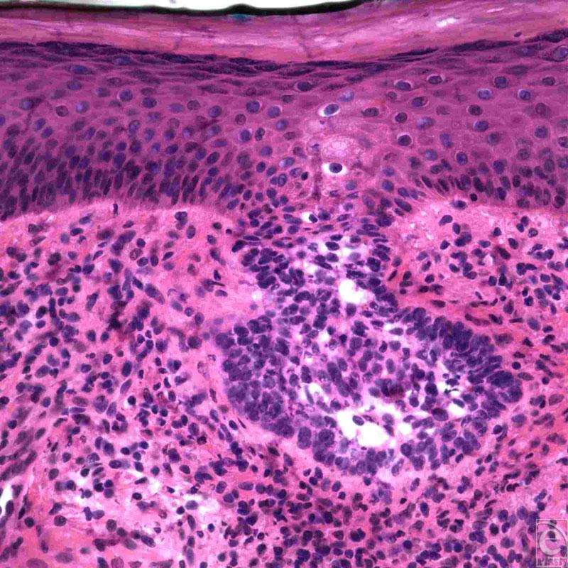 eplasty VOLUME 10 Figure 2. Superficial spreading basal cell carcinoma.