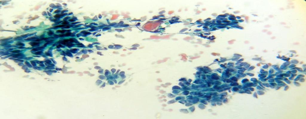 Figure 2: Cytology showed tumor cells which were uniform, small basaloid, having high nucleo-cytoplasmic ratio with round, hyperchromatic nuclei and scant cytoplasm.