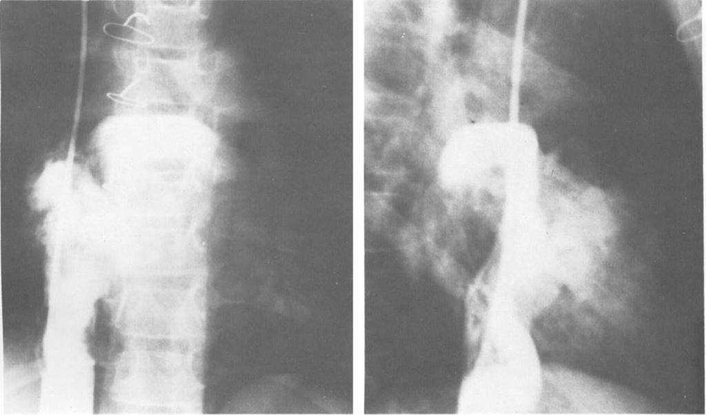 293 Desnicketal: Right-to-Left Shunt after ASDRepair A B Fig 1. (Patierit 4.) (A) Antevoposteviov and (B) /ntrr.nl irrferior zieiii7 cnz~ogri7rri.