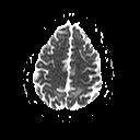 MRI imaging Parieto-occipital subcortical